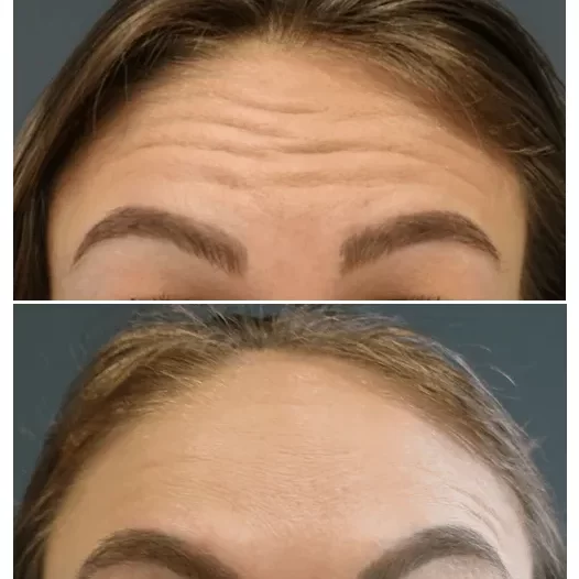 Botox before and after