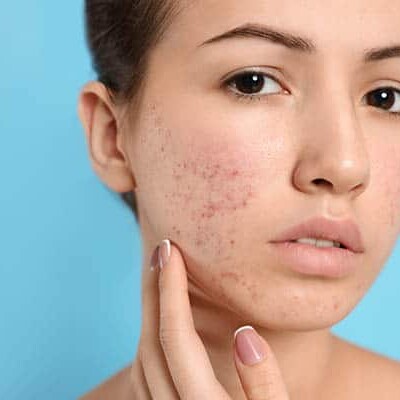 Teen girl with acne problem on light blue background